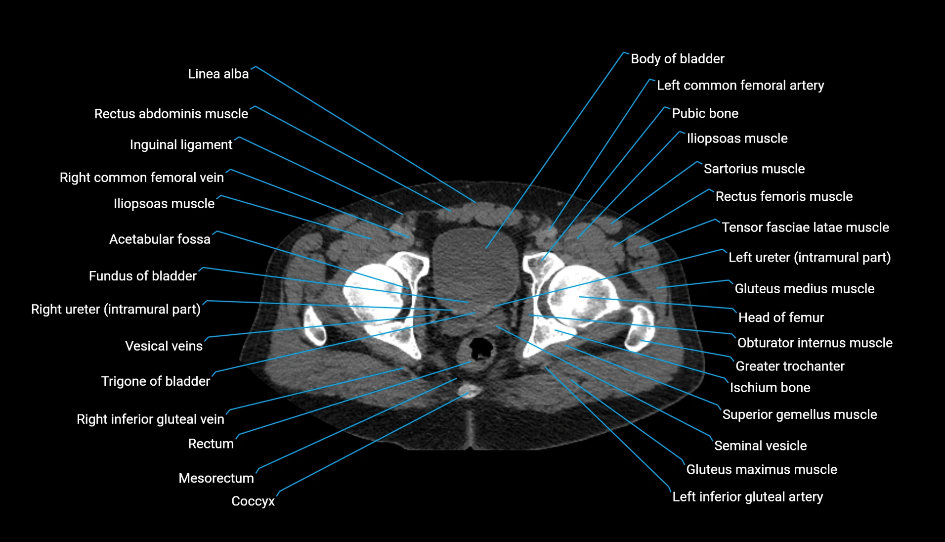 CT urogram axial cross sectional anatomy  labelled radiology image-00235.webp